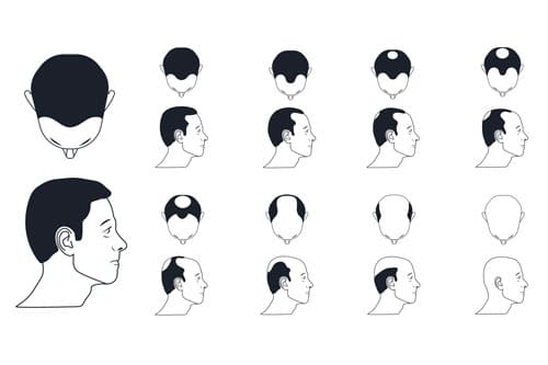 etapy wypadania włosów u mężczyzn