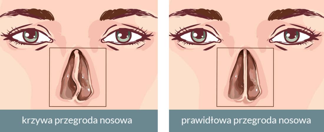 Porównanie krzywej przegrody nosowej z poprawną przegrodą nosa